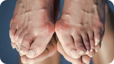 Как подобрать ортопедические стельки при вальгусной деформации - фото